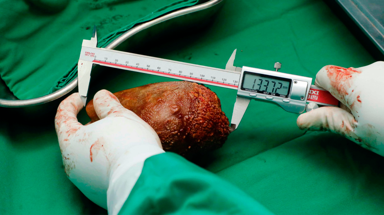 /internacional/asia/record-guinness-extirpan-el-calculo-renal-mas-grande-y-pesado-del-mundo